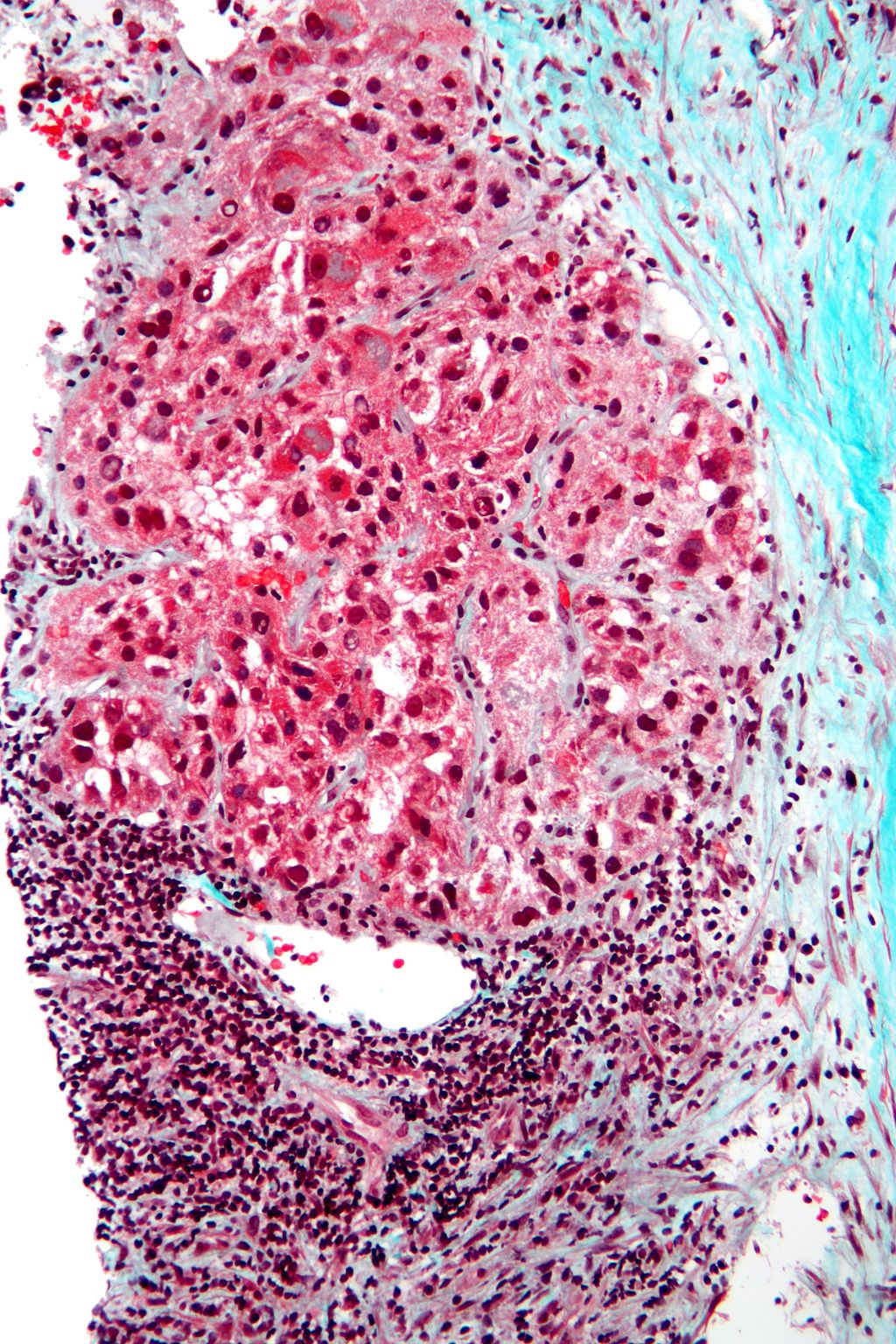 micrograph of liver cancer