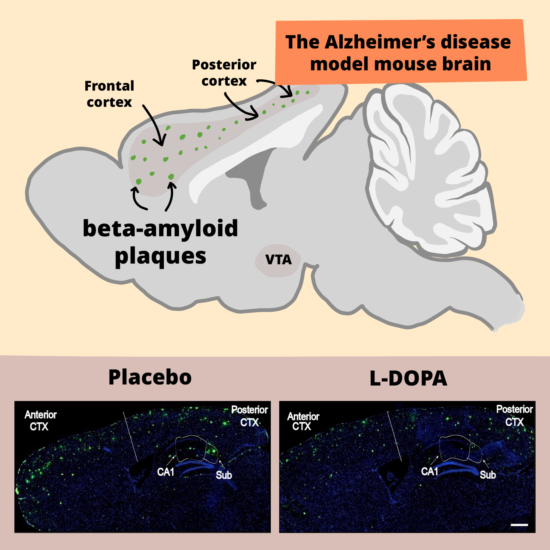 La dopa reduce el beta-amiloide