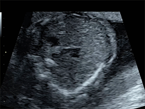 Abormal fetal heart