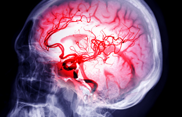 The first drug treatment for brain aneurysms (in mice)