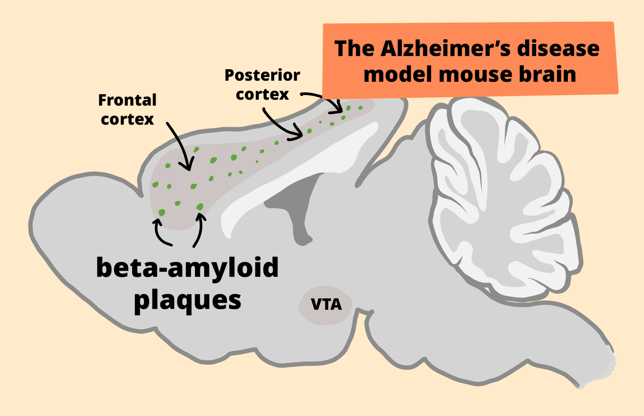 Dopamine reduces beta-amyloid plaques in Alzheimer’s disease