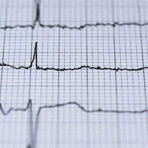 ERRg predicts atrial fibrillation and hidden comorbidity