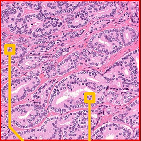 AI identifies features associated with cancer recurrence