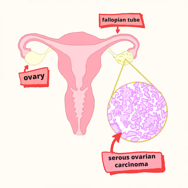serous ovarian cancer
