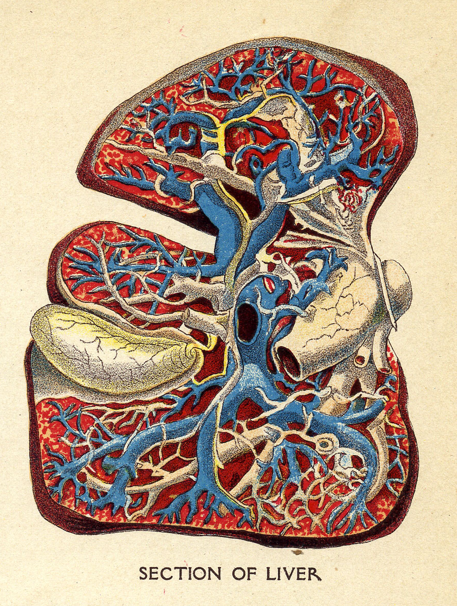 Hepatoma (liver cancer) blocked by a sugar look-a-like