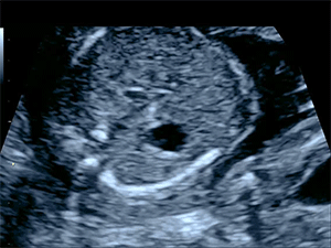 Normal fetal heart