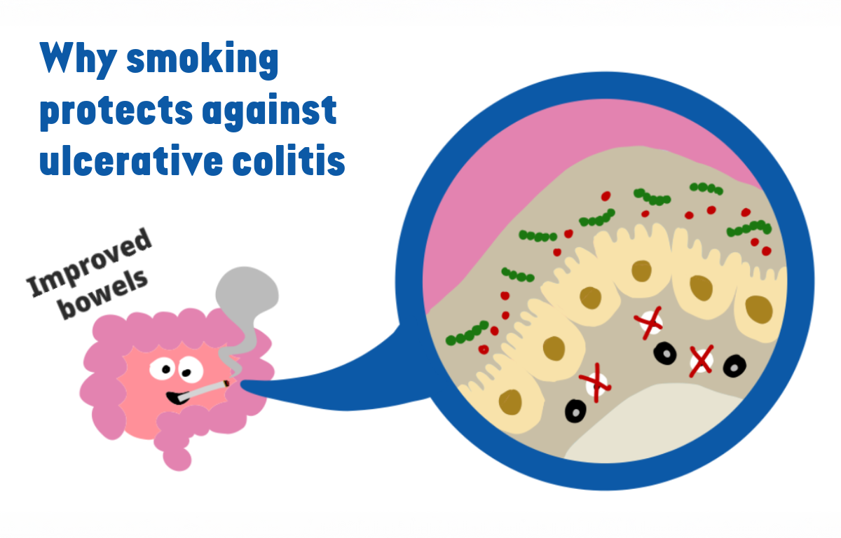 Smoker gut bacteria reduce bowel inflammation in ulcerative colitis