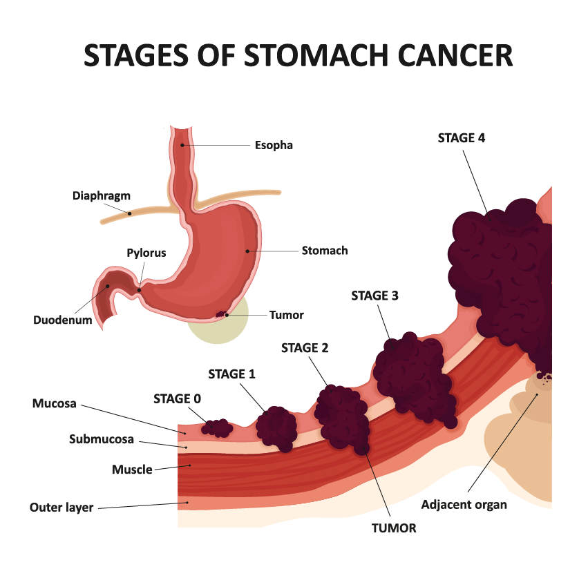 stomach cancer