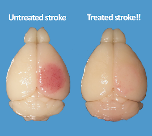 AdR blockers protect the brain from stroke damage