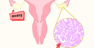 serous ovarian cancer